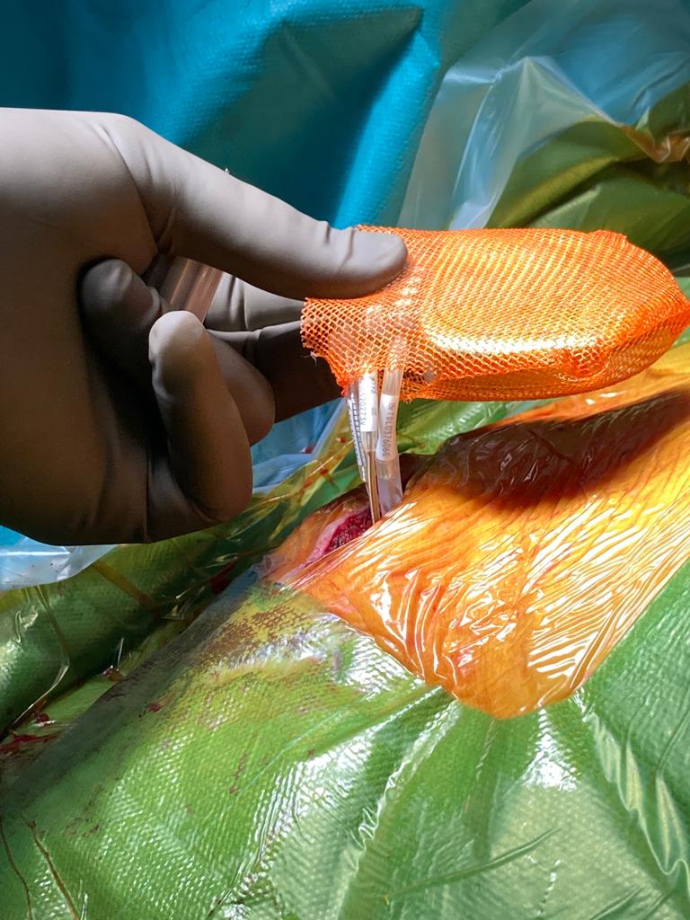 How do you use the TYRX envelope #epeeps ? I like to dip, flip and slit. <a href="/Medtronic/">Medtronic</a>