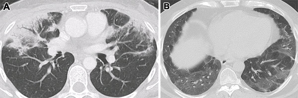 Diffuse alveolar damage (DAD) and organizing pneumonia (OD) are the major manifestations of lung injury. Learn how to best participate in a multidisciplinary approach to patients with lung injury. bit.ly/3NVUtsj