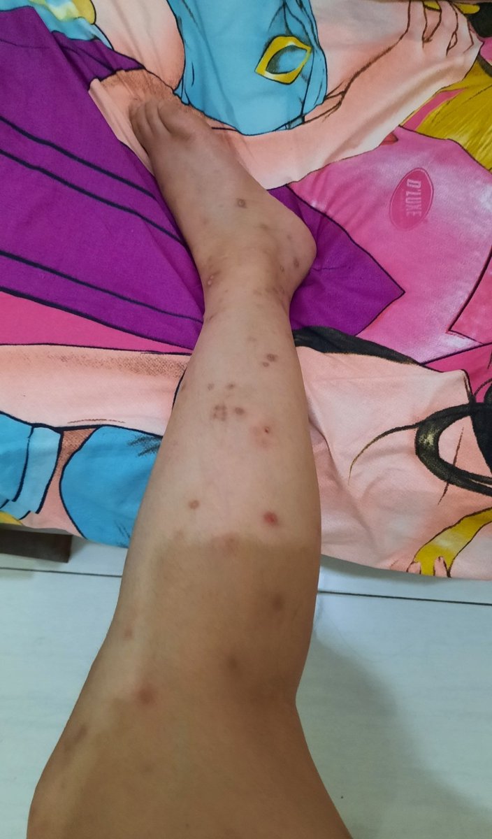 shinchancapek's tweet photo. aku mau sharing gimana aku ngilangim bekas luka ((lagi)) mungkin bbrp kalian udah pernah liat threadku sebelumnya karena emang aku bener bener selalu survive dengan kaki boncel, koreng, beserta bekas luka kek gini🙂🫠🖕🏻

jadi — https://t.co/SKMaJZVLBg