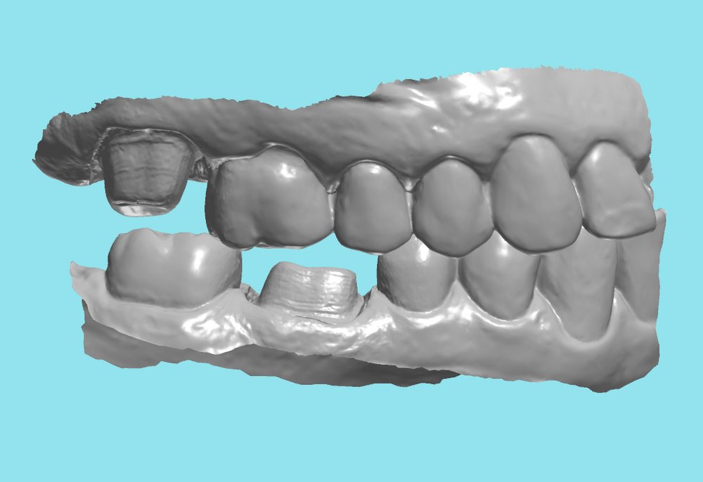 ddldental's tweet photo. When submitting cases for posterior units, a quadrant scan that includes the canine works well.

https://t.co/EqLEy4K0Ju

#digitaldentistry https://t.co/YcVKqKyH5Q