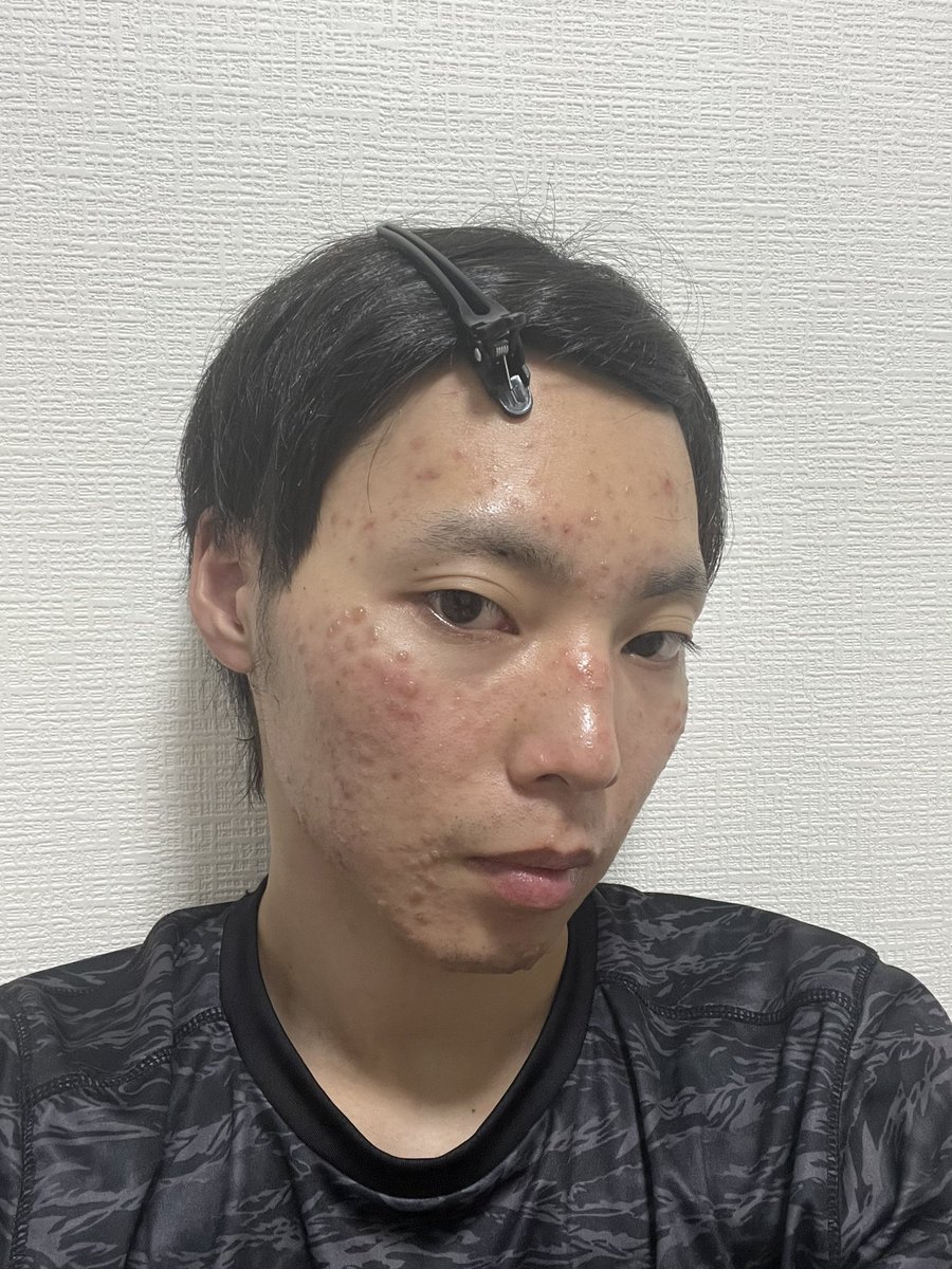 ren_00426's tweet photo. 水膨れになってるんだけど普通にやばくない？
本当に3日で治まるのかな https://t.co/x5Hl0dlAdU