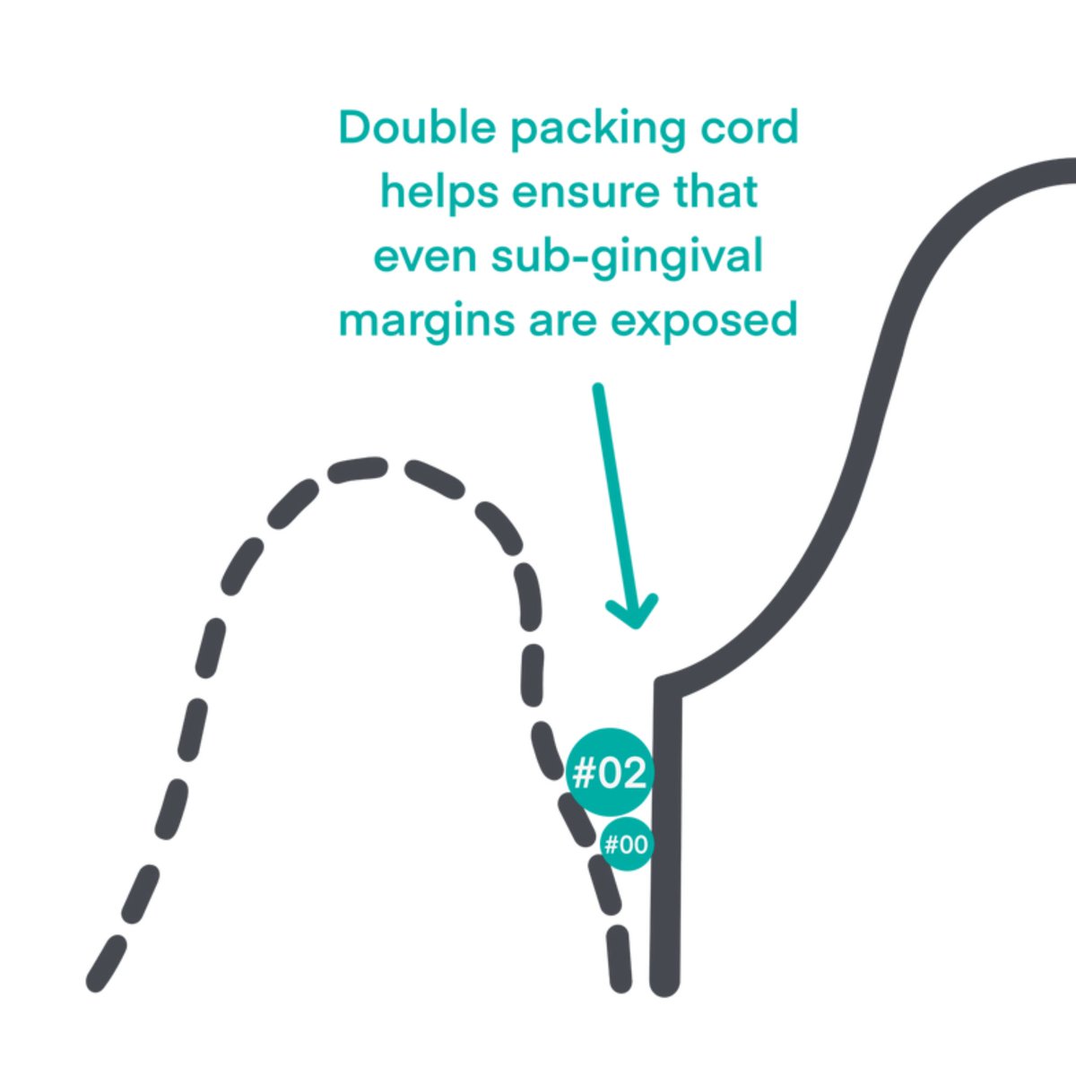 ddldental's tweet photo. Margins should always be clearly visible and distinct from the tissue or saliva in the scan: we recommend double packing cord and removing the top one before scanning.

https://t.co/EqLEy4Kyz2

#digitaldentistry https://t.co/nJGMtKNTNY