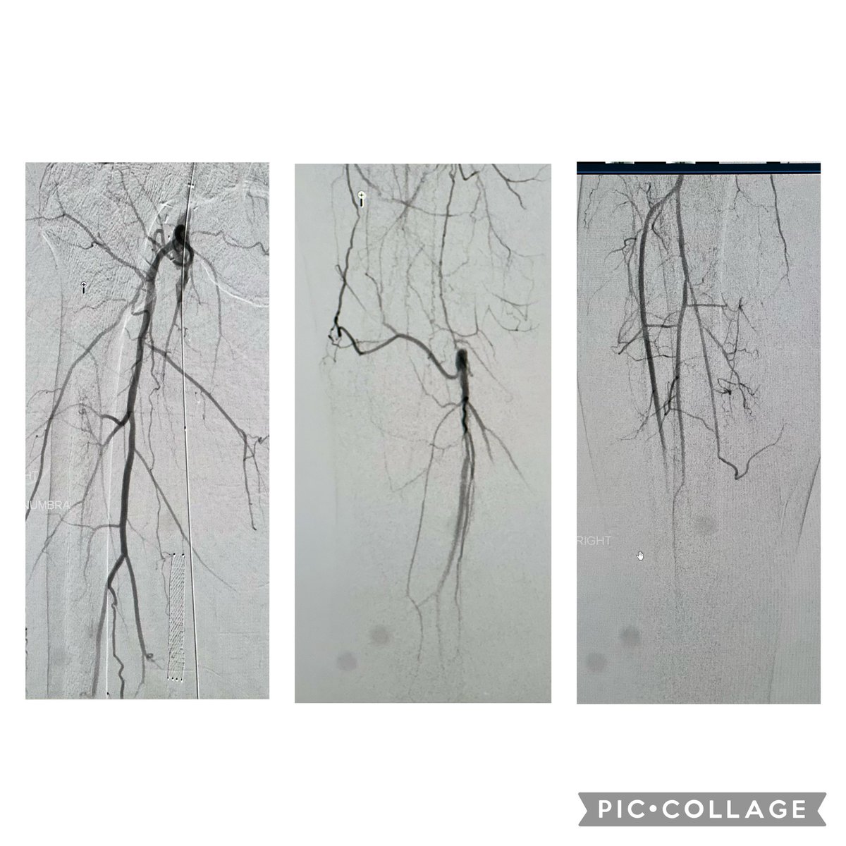 tyler_braaten's tweet photo. ALI with thrombosed fem-pop bypass. On xarelto, elected to forgo tPA lysis due to bleeding risk. Suction thrombectomy only. Symptoms resolved.

We typically lyse especially with distal emboli. Is anyone considering tPA when on DOAC?

@SIRspecialists @ACCinTouch @VascularSVS https://t.co/5qgcb6rj2C