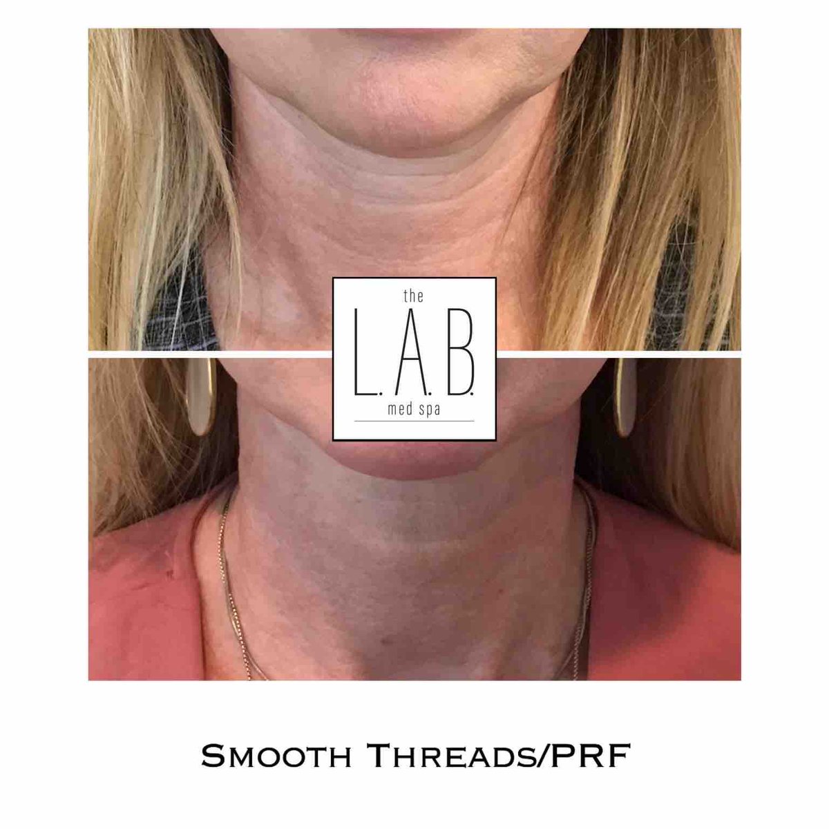 beautiscience's tweet image. When your injector, aesthetician, or skincare pro says that a combination treatment would help- LISTEN! 

Threads + PRF= *perfection*

#smooththreads #prf #thelabmedspa #southlaketx