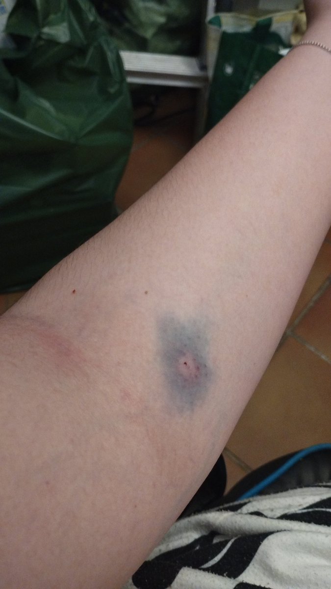 helvet_'s tweet photo. Esta es la carnicería que me han hecho hoy al donar sangre (sí, me he presionado como me indicaron, llevo 6-7 donaciones y nunca antes me habia pasado esto) encima segun los enfermeros no valgo para donar, que buena experiencia 🥰🫶🏻 https://t.co/0ilLAZcSd4