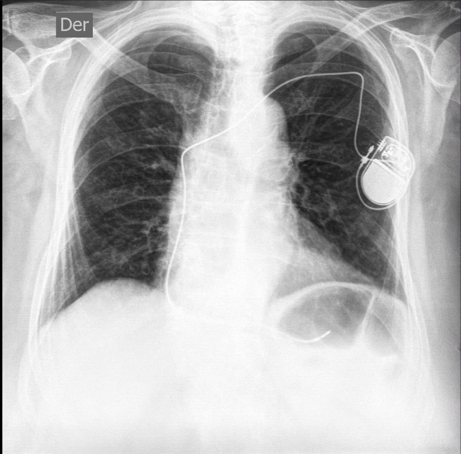 ALFIEEP1's tweet photo. s/p pacameker implant 1 month ago.
Lead doesn’t capture.
Nice picture for rounds.
What is happening? https://t.co/mgfhhwf8ds