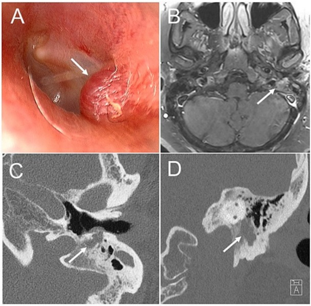 Mayo Clinic ENT (@mayoclinicent) on Twitter photo What is the progression and symptomology of facial paraganglioma, and what are management options?
Click to read more: bit.ly/3YdCZMH
#MayoClinicENTResearch #MedTwitter <a href="/MattCarlsonMD/">Matthew L. Carlson, MD MBA</a> <a href="/dr_douse/">Dontre’ M. Douse, M.D.</a> What is the progression and symptomology of facial paraganglioma, and what are management options?
Click to read more: bit.ly/3YdCZMH
#MayoClinicENTResearch #MedTwitter <a href="/MattCarlsonMD/">Matthew L. Carlson, MD MBA</a> <a href="/dr_douse/">Dontre’ M. Douse, M.D.</a>