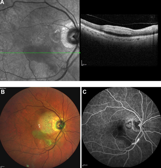 Adverse events related to intraocular inflammation occurred in 53/505 (10.5%) patients on brolucizumab in the  OCTOPUS  Incidence of and SWIFT  intraocular inflammation  prospective trials, mostly during loading  phase with retinal involvement was 3.4%. ow.ly/mmjY50P53tt