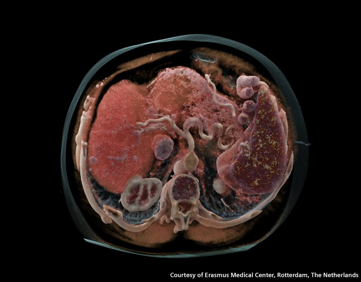 Medical Masterpieces: NAEOTOM Alpha, the first photon-counting #CT provides a POWERFUL combination of spatial resolution, spectral information and acquisition speed for potential evaluation of TUMOR RESPONSE.

siemens-healthineers.com/en-us/computed…

<a href="/SiemensHealth/">Siemens Healthineers</a> #radiology#oncology