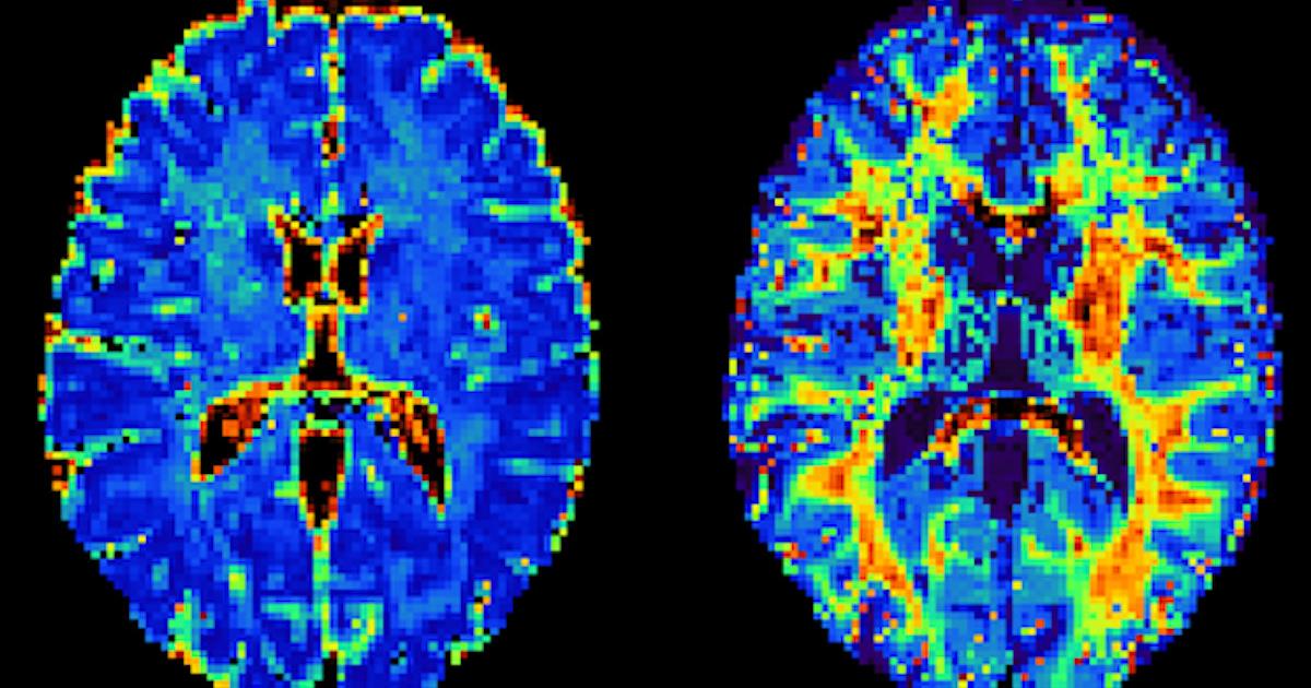 Better characterization of disease progression gained through quantifying microstructure features with #diffusionimaging can lead to huge benefits for neurological patients, award-winning Swiss researchers say. buff.ly/3NXsybl #radiology #mri