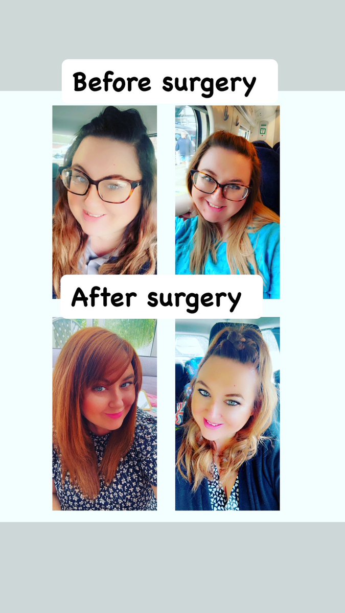 Crazy what a few weeks can do! 

#wls #vsg #vsgcommunity #weightlossjourney #weightlosstransformation #bariatricsurgery #vsgtransformation #vsgjourney #ukgastricsurgery #gastricsleeve #wlscommunity