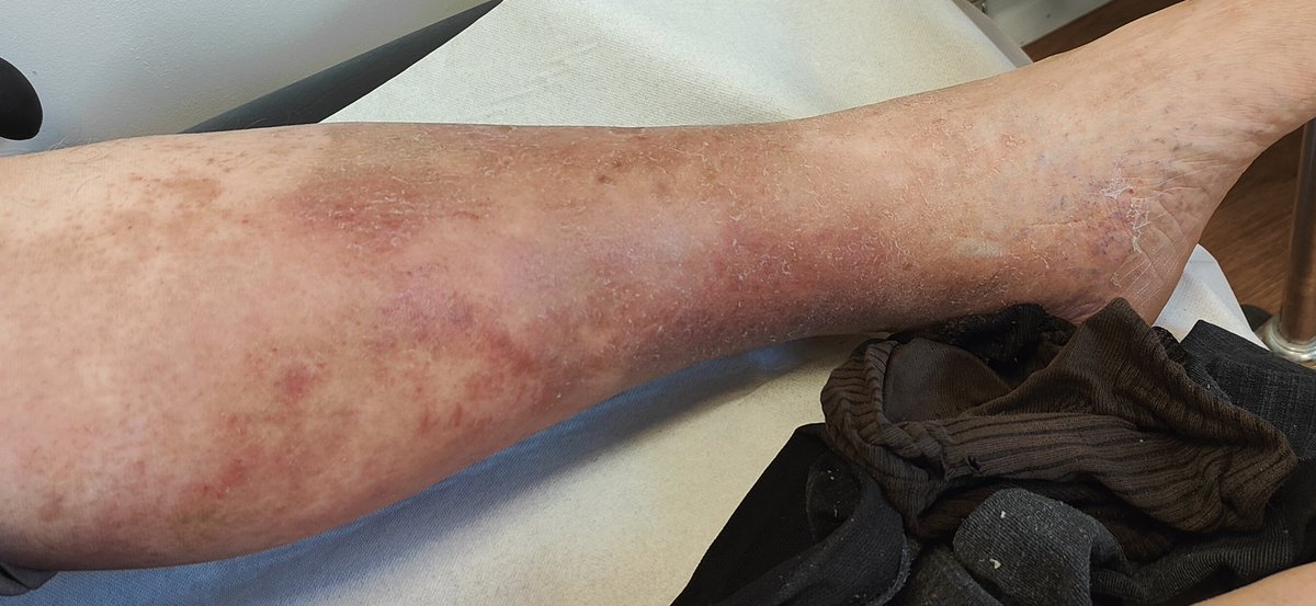 VElangasinghe's tweet photo. Sclerosing panniculitis of lower limbs commonly misdiagnosed as cellulitis requires a multipronged intervention eg anti inflammatory, compression and skin care regimen. Can reduce a lot of unnecessary antibiotic. @VenousNews @vasculardis @mrcgp @bmj_latest @HealthySkin4All https://t.co/ruEjEQvEdT