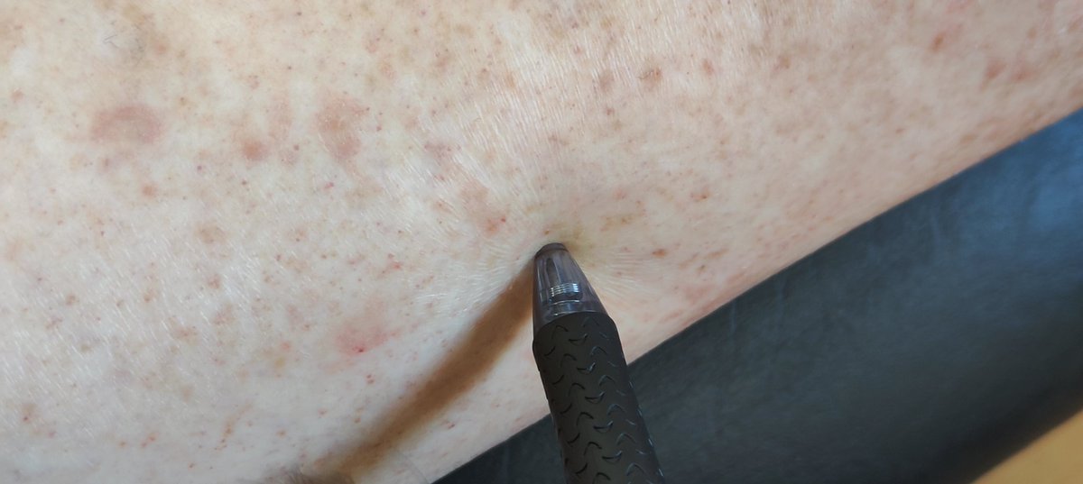 VElangasinghe's tweet photo. Compare the recoil and loss of elasticity with normal skin. Signifies the sclerosis. ESR usually very high compared to CRP unlike in cellulitis. https://t.co/iSI589ilGO