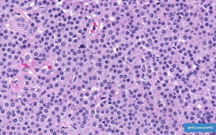 MELanocyteMD's tweet photo. NEW RESIDENT UNKNOWNS:
CASE #2

30♀️ w/ tender nodule on arm

🔬 WSI: https://t.co/Yg6yIoe8kf
💡 Answer: https://t.co/F8CvYbJCR7
📺 Video: https://t.co/WeHyuyJ5o4

#dermpath #bstpath #kiko25 https://t.co/7xObV6lC0y