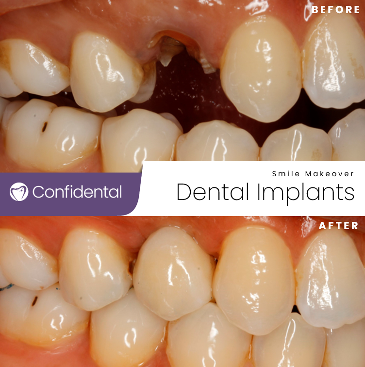 ConfidentalUK's tweet photo. 🦷 Our latest dental success story will make you smile! 😁 Say hello to the newest member of our patient's dazzling smile - a single tooth implant! 🌟 We are thrilled to have brought back their confidence and restored their beautiful smile. 💯 #DentalImplants #SmileTransformation https://t.co/86pkZ5DHzN