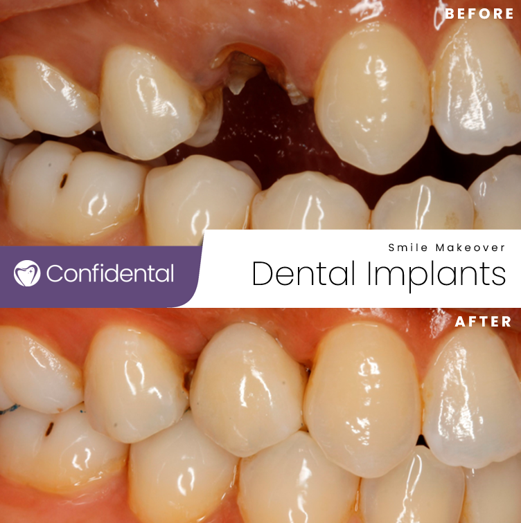 🦷 Our latest dental success story will make you smile! 😁 Say hello to the newest member of our patient's dazzling smile - a single tooth implant! 🌟 We are thrilled to have brought back their confidence and restored their beautiful smile. 💯 #DentalImplants #SmileTransformation