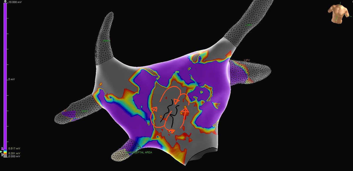 mertilkerh's tweet photo. 66 y,F with incessant SVT wthout #ablation history. First lesion provided tur NSR . Thanks @NurigunayEP for the great maps. https://t.co/e5gFM3PwyA