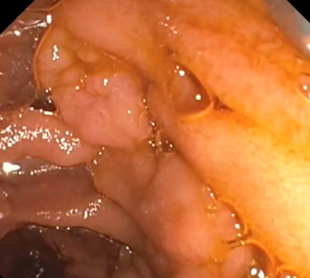 VideoGIE Journal (@videogie) on Twitter photo Amandeep Singh et al demonstrate "Wire-traction device–assisted papillectomy of retracted papilla" in an Original Article recently published by VideoGIE. videogie.org/article/S2468-…
@chahalprabhleen <a href="/AmandeepSinghMD/">Amandeep Singh</a> <a href="/amitbhattMD/">Amit Bhatt MD</a> Amandeep Singh et al demonstrate "Wire-traction device–assisted papillectomy of retracted papilla" in an Original Article recently published by VideoGIE. videogie.org/article/S2468-…
@chahalprabhleen <a href="/AmandeepSinghMD/">Amandeep Singh</a> <a href="/amitbhattMD/">Amit Bhatt MD</a>