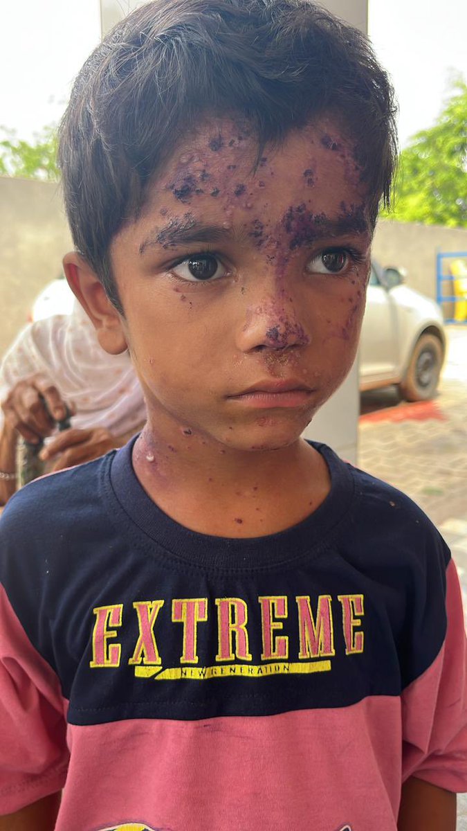 SinghSwaiman's tweet photo. Our team is seeing a rise in skin conditions from flood waters and using dermatologists amongst other specialists thru telemedicine services to help along with doctors on ground.  Some are exacerbation of chronic diseases but many are acute infections.  Fungal skin infection can be extremely hard to treat and medications have a high side effect profile.  So again please stay out of water and get checked if you are seeing skin breakdown. If you are a Dermatologist or a doctor who wants to help thru our telemedicine services (via phone or our EMR) please email join5heart@gmail.com or call/WhatsApp our help line numbers. #1 +91 98152 97372 #2 +91 98728 25823