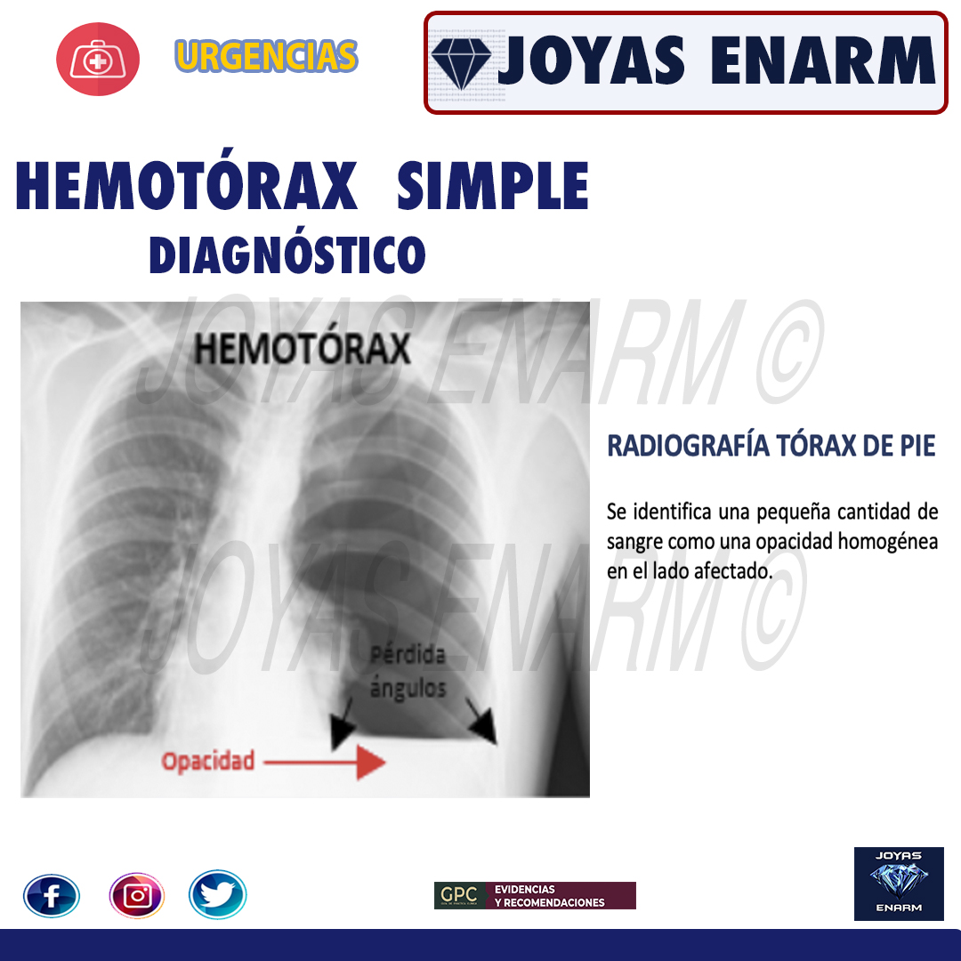 Joyas_ENARM's tweet photo. REPASO  HEMOTÓRAX:

💎 https://t.co/O0EgHOujZP 💎
#ENARM #ENARM2023 https://t.co/GtmRF9yYfN