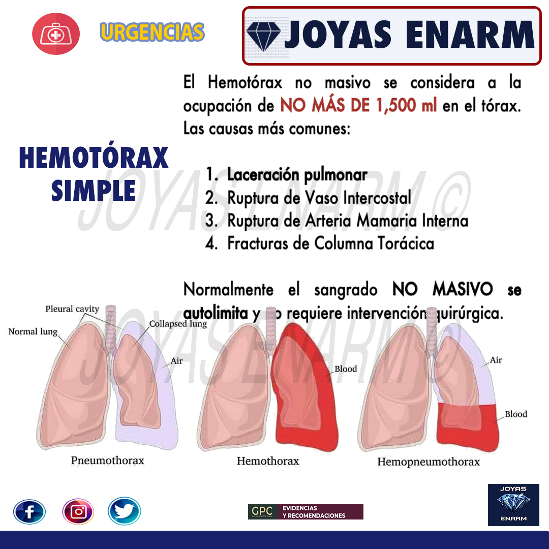 Joyas_ENARM's tweet photo. REPASO  HEMOTÓRAX:

💎 https://t.co/O0EgHOujZP 💎
#ENARM #ENARM2023 https://t.co/GtmRF9yYfN
