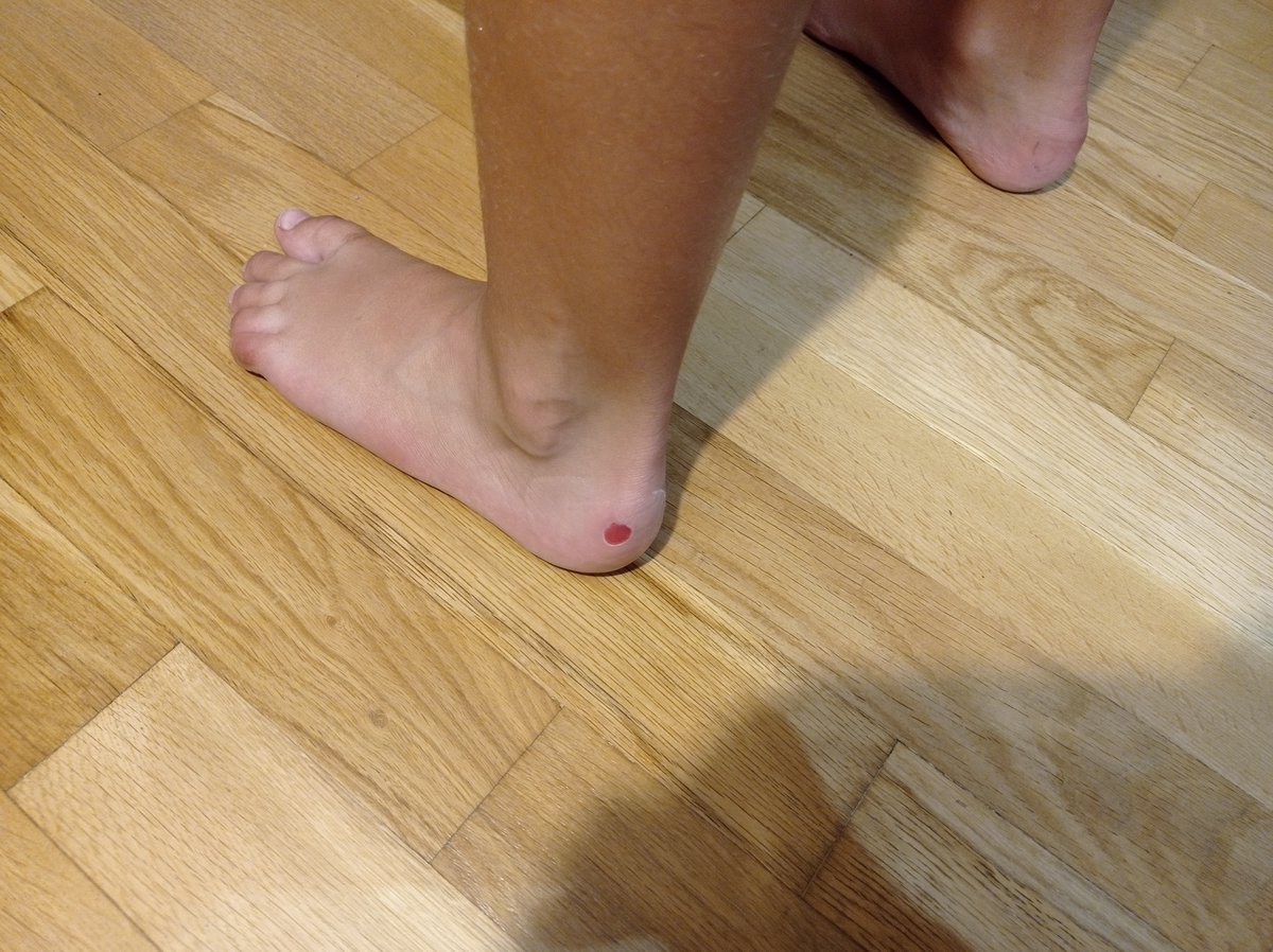manel_david's tweet photo. @adidas_ES Me gasto 150€ en una predator y mira  que ampollas le han hecho en el pie. Es justo en el talón dónde acaba el acolchado. Y encima  en la tienda me deniegan la devolución del dinero o el cambio por otro modelo. https://t.co/VTPBqm44lh