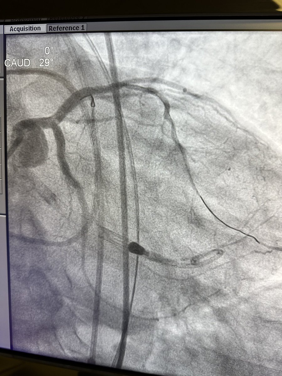 Thank you @UWCathLab and @DrBillLombardi for having me as a live case operator. Outstanding cases and fantastic learning! Special shout out to my co-operators, @KateKearney4 and @RhianEDavies1! Looking forward to even more collaboration with @UWMedHeart and @MGHHeartHealth.