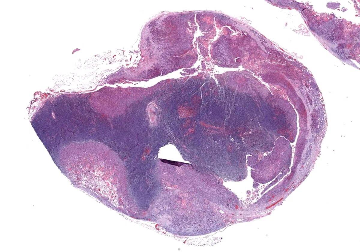 75 yo M. Enlarged axillary lymph nodes. Your diagnosis? Digital slides: https://t.co/cJbf5E30Qu. Answer & video: https://t.co/iy1z8Pxu4M. #pathology #pathologists #pathTwitter #dermpath #dermatology #dermtwitter #hemepath https://t.co/IEM093TjM1