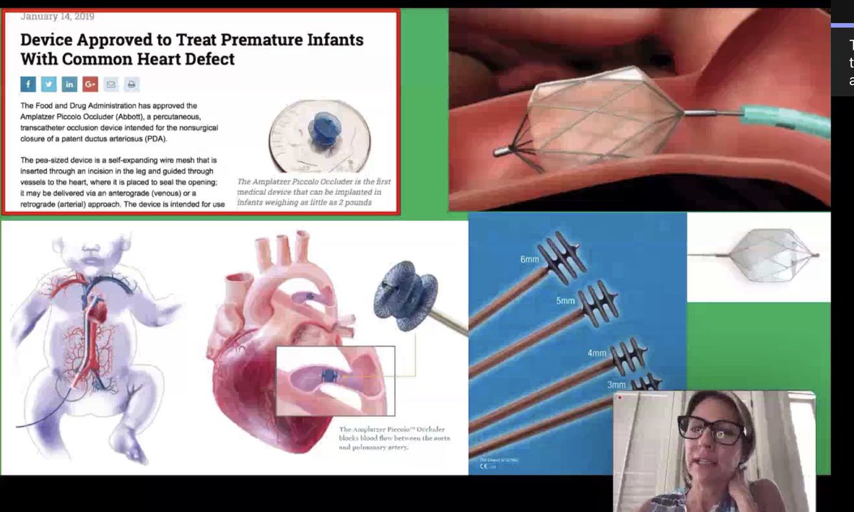 songMD's tweet photo. #NeoPDA morphology changes at 32w PMA, regardless of GA,➡️ shorter/fatter, making it harder for TC occlusion device to stay in place as ⬆️ age.
TCPC assoc w/ ⬇️ or NO post-opt opioid need, &amp; NO post-ligation scoliosis risk 
#LifeLongLearning
#NeoGR https://t.co/uLTwhQfToh