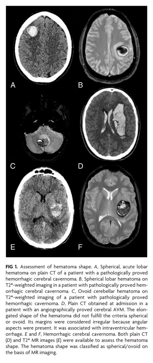 TheAJNR's tweet photo. "Early Detection of Underlying Cavernomas in Patients with Spontaneous Acute Intracerebral Hematomas" #Cavernomas #IntracranialHemorrhage | https://t.co/QLDzi43ILu https://t.co/7ZO1Idn7OQ