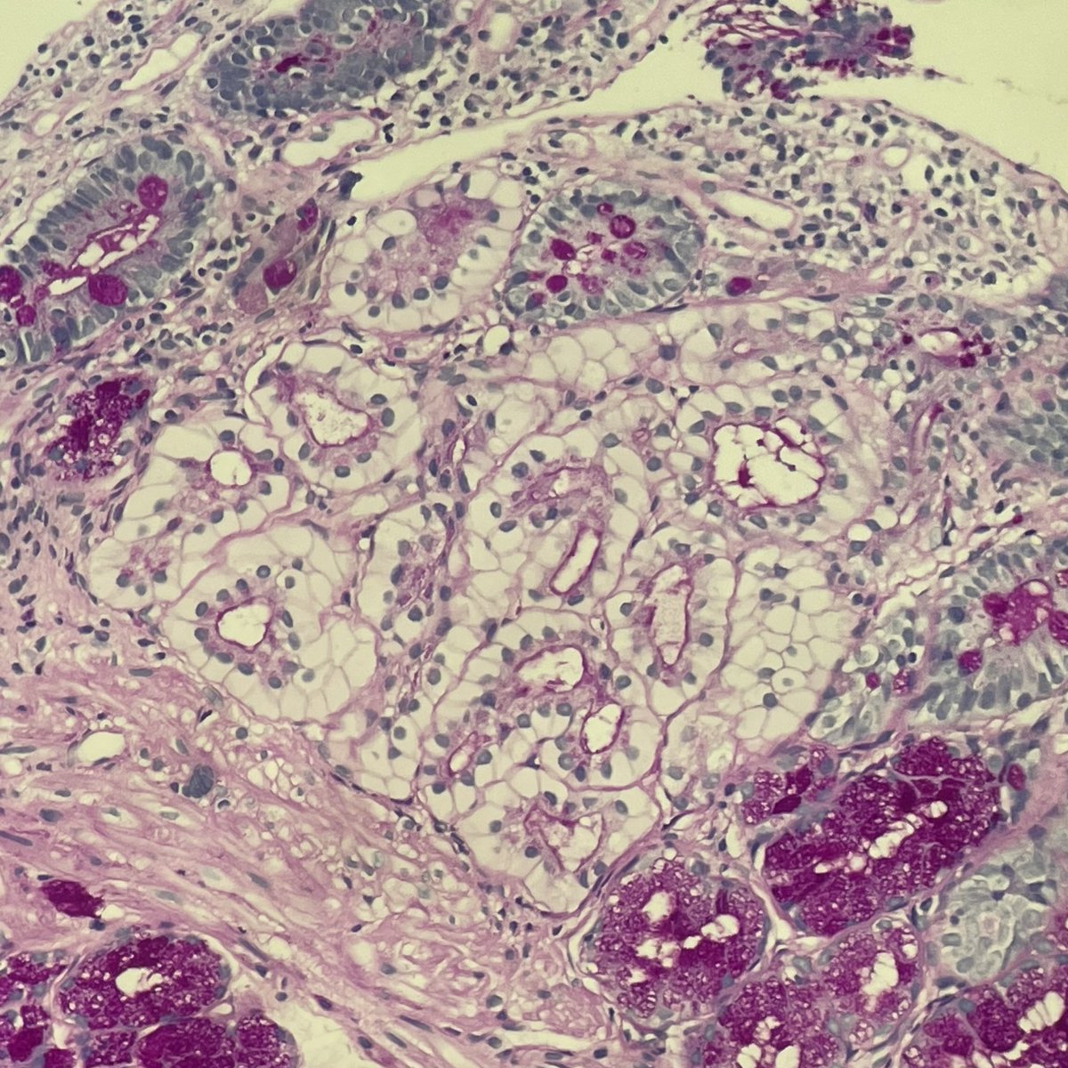 jcksalex's tweet photo. First time seeing this one. Duodenal biopsy. What is it and what is the clinical significance?
#pathology #gipath https://t.co/OSWHtDYV8e