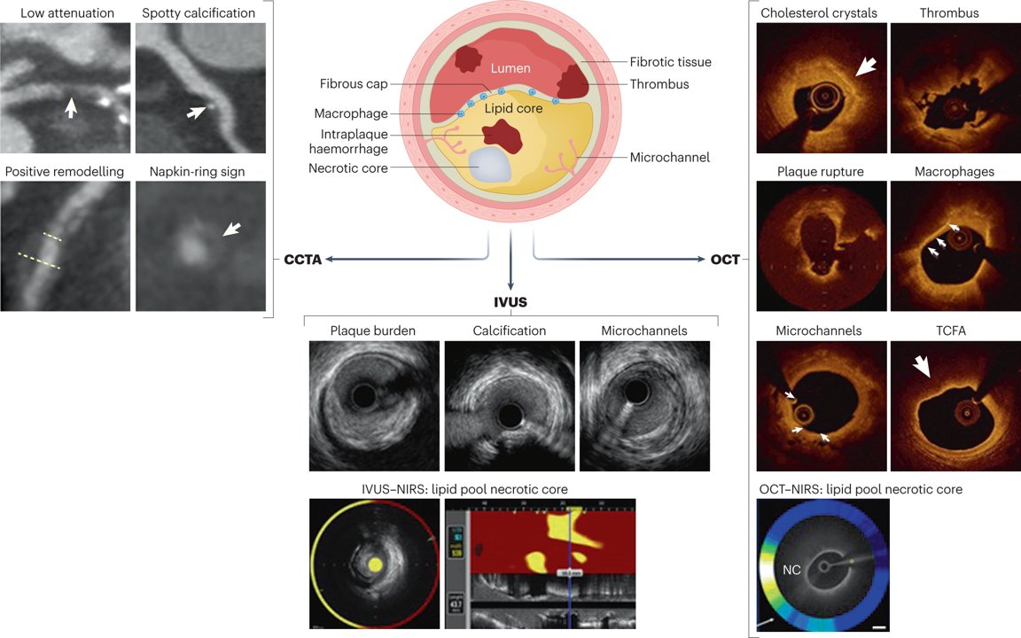 In our latest Roadmap article, @ProfDewey and colleagues review the existing data on the application of #artificialintelligence to the imaging of vulnerable plaque in coronary arteries | rdcu.be/dhgot