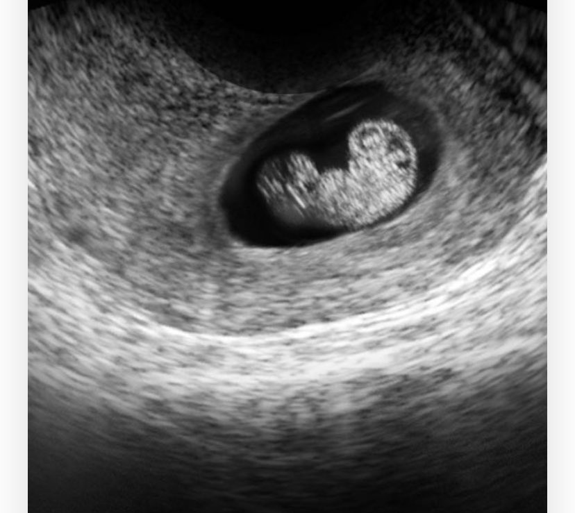 ⠀⠀ 

             ⠀⠀⠀                               ( 🧸 )
                                        6 weeks pregnancy .

    ⠀  ⠀   ⠀⠀  ⠀ ㅤㅤㅤㅤ