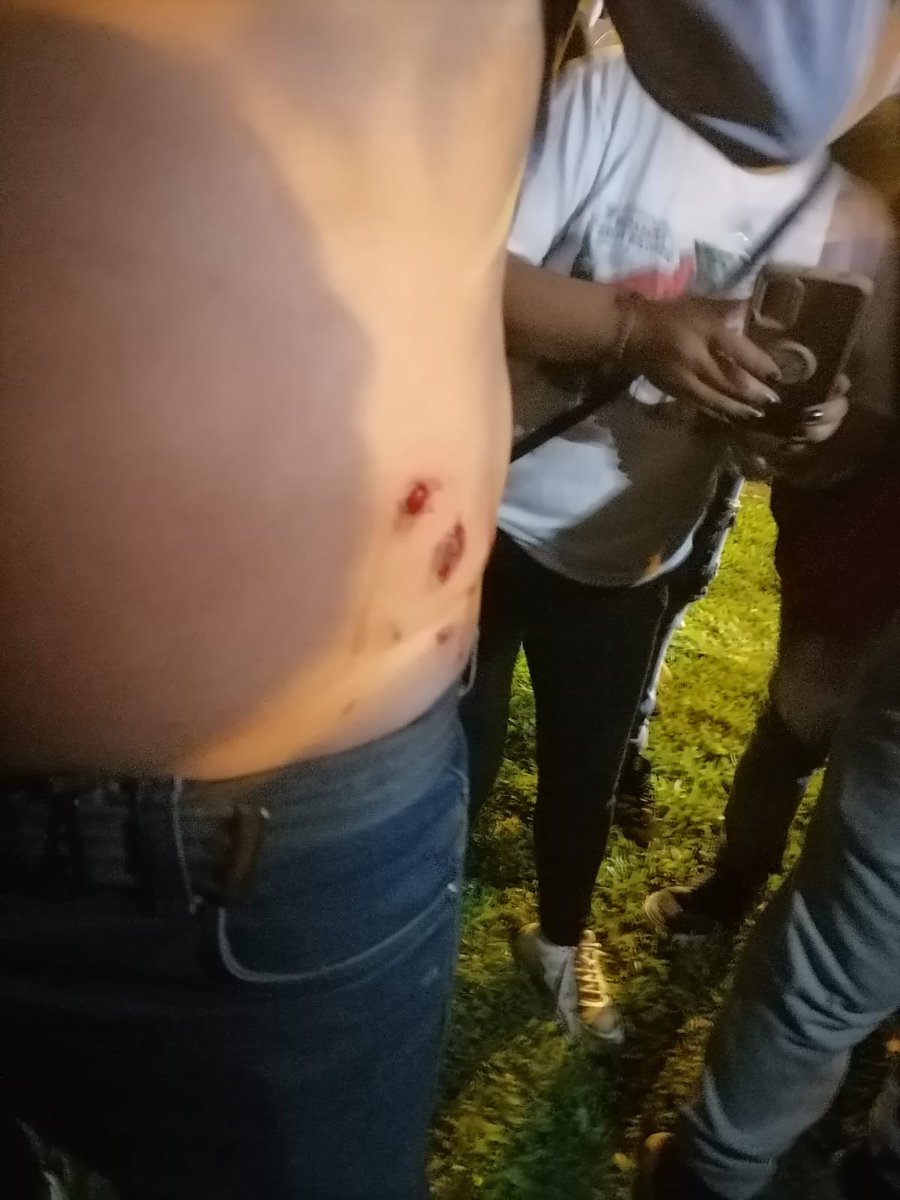 Aquí otra denuncia de otro herido por perdigones. 
Centro de Lima