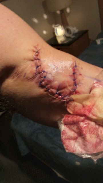 smokerockhard's tweet photo. gonna have a sweet scar 🤫😈😈😈 #surgery #2023medicine #electrocution https://t.co/peCGTdQF9U