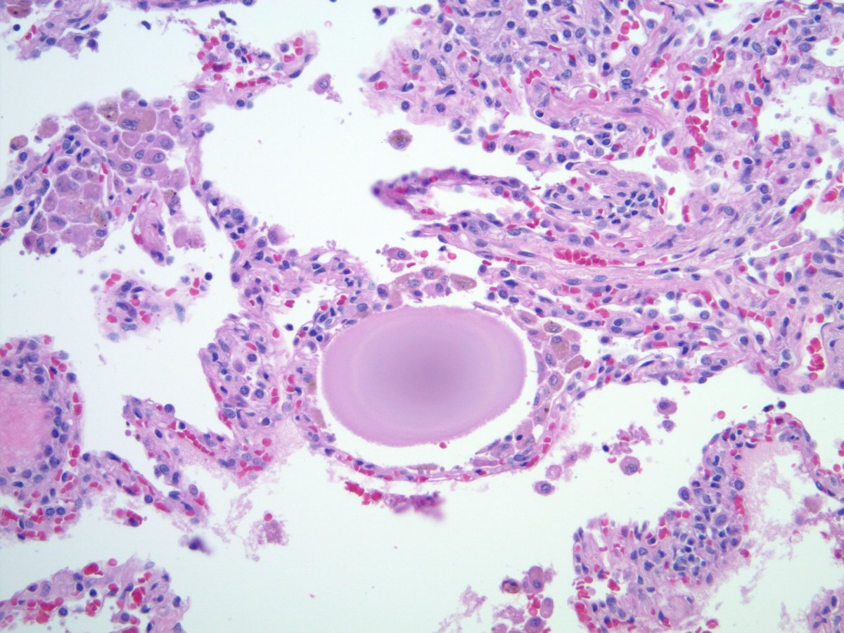 Incidental findings in lung resections: see, appreciate, and move on. Can you name all 4? #pathology #pulmpath