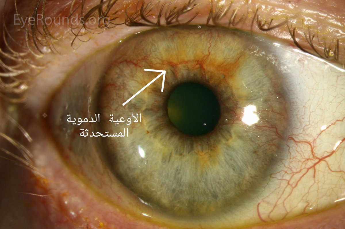 DrMohannadAlQu1's tweet photo. Neovascular Glaucoma
(جلوكوما الأوعية الدموية المستحدثة)
يحدث هذا النوع من الجلوكوما نتيجة إعتلالات الشبكية التي تؤدي إلى نقص التروية للشبكية ممايؤدي إلى تكون أوعية دموية مستحدثة غيرطبيعية تغطي مجرى تصريف الخلط المائي بزاوية العين وبالتالي ارتفاع ضغط العين وتأثر العصب البصري. https://t.co/ZCiwaYsOmH