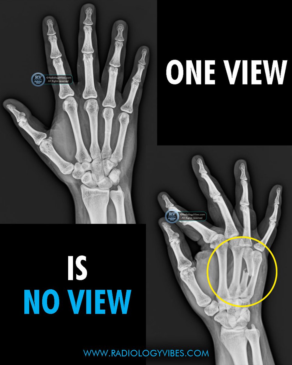 'One view is no view'

#radres #radiology #Foamrad #MedTwitter #FOAMed  #orthotwitter #FRCR #Usmle