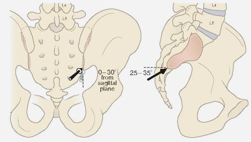 RubenAlvarezDoc's tweet photo. Sacroiliac Intraarticular Joint Injection
✅Tilt cephalad 20
✅Oblique contralaterally 20 until the anterior and posterior aspects of the joint overlap
✅Target medial joint space 1-2 cm sup to the inf of the joint
@quironsalud Bizkaia Vitoria
@ClinicaEdolor #painrelief #pain https://t.co/3IoYd92wIG