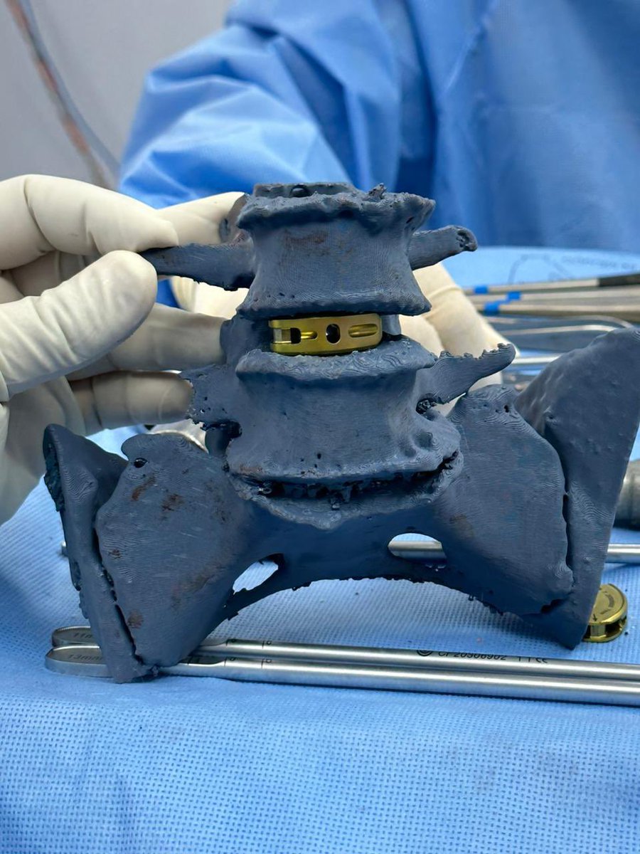 OrtoDrJuarez's tweet photo. Columna y guías paciente-especificas para tornillos transpediculares #orthotwitter #3dcot #3dprint #spine https://t.co/3JEIN3WWo3