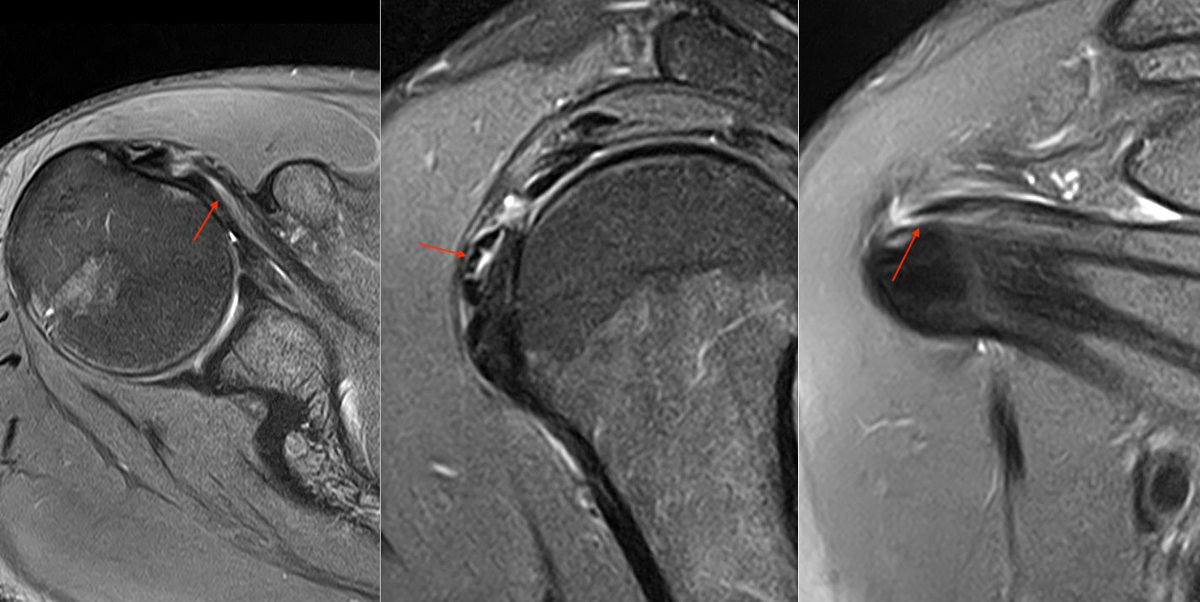 Interstitial tears of the subscapularis with delamination are relatively common, often misdiagnosed, and are very painful.