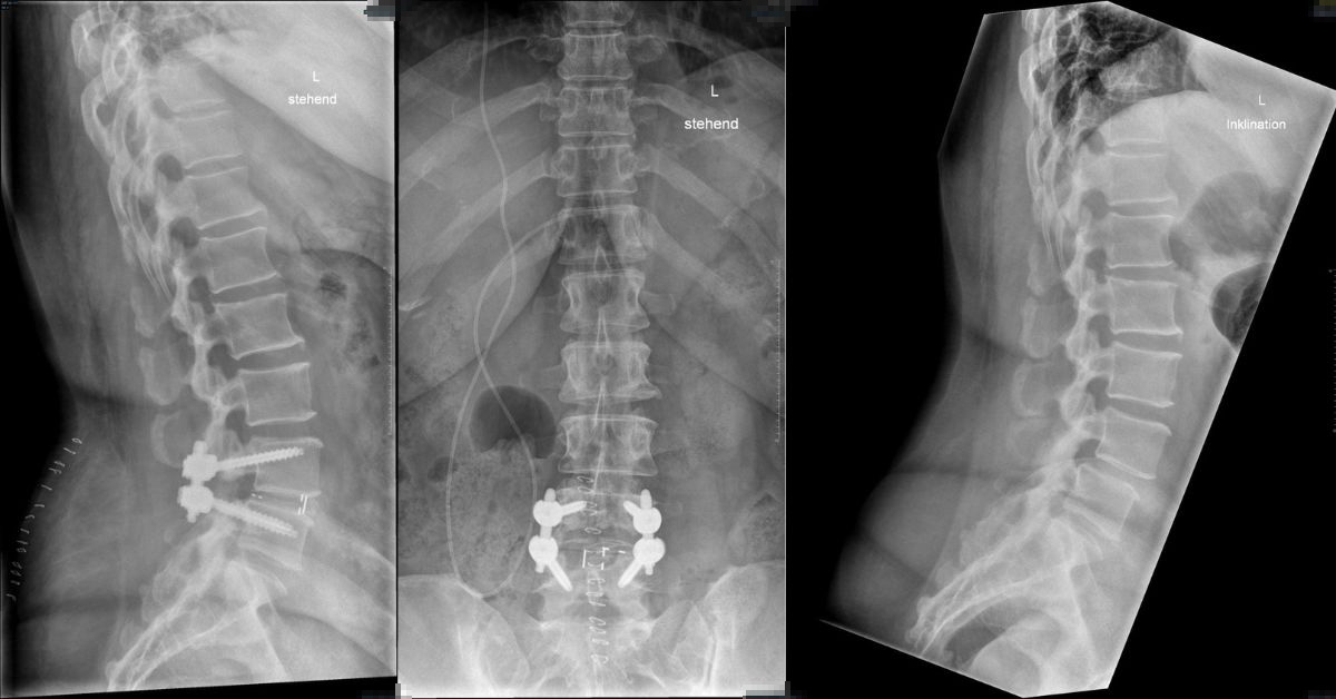 Brainlab's tweet photo. We would like to extend a big congratulations to @MarkusGBruder, MD, Prof. @SchubertGA MD, Julien Jost, MD &amp; Debora Cipriani, MD for performing the first robotic-assisted spinal instrumentation using Cirq in Switzerland at @ksagruppe! 
 
#surgery #neurosurgery #robotics https://t.co/MfxF2eNRVX