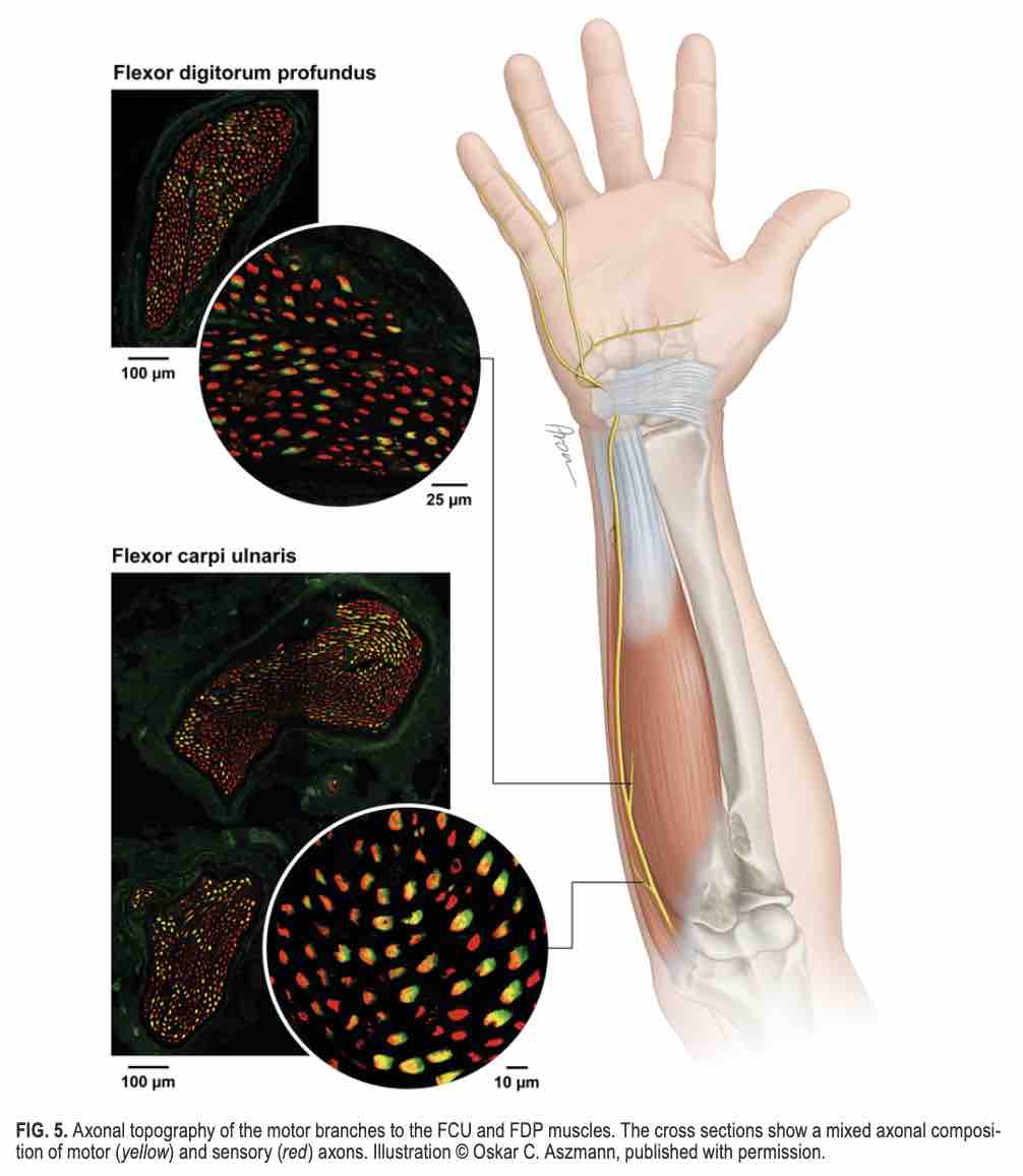 TheJNS's tweet photo. #OnlineFirst: Axonal mapping of motor and sensory components within the ulnar nerve and its branches. 

https://t.co/izj3SHEwhj. https://t.co/R51Tt5ew5M