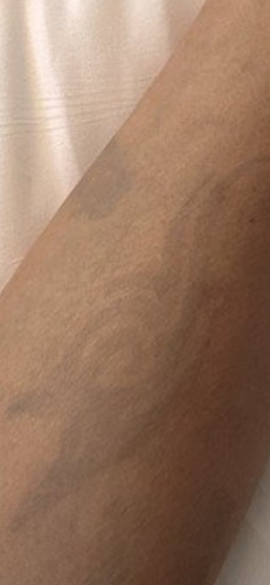 FractalHIS's tweet photo. Drunk in KeyWest from 5 STRONG Mojitos, and decide to get a temporary tattoo.  What can possibly go wrong?  
 What was attempted at 1:30AM, vs. the aftermath when i woke this morning 😂 https://t.co/W7dKgwSUVl