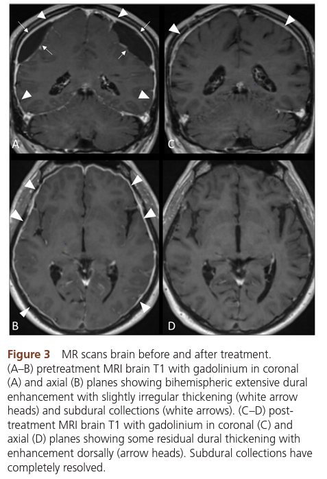 KingsNeuro's tweet photo. Report of a neurological rarities @PracticalNeurol 
'IgG4-related hypertrophic pachymeningitis with chronic subdural hematoma' highlighting a fruitful multidisciplinary discussion @KingsCollegeNHS.  
Read more: https://t.co/tx6RcyRHZD
@lavrador_jose @dim_kalaitzo @NeuroradLal https://t.co/uJQIgBQdaG