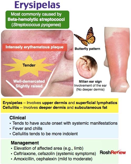 PeterItebimien's tweet photo. @mendietaalex1 Erysipelas
bacterial skin infection involving the upper dermis that characteristically extends into the superficial cutaneous lymphatics. It is a tender,intensely erythematous,indurated plaque with a sharply demarcated border
It is mostly caused by strep pyogenes.Rx antibiotics https://t.co/OyyAZ7fq2R