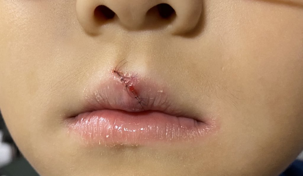 no_fever's tweet photo. @Dyson Hair Dryer's FlyAway Smoother nozzle
got hit in my kid’s face. His lip was torn and suture surgery was performed. The child was injured by his mistake, but @Dyson needs to improve the sharp part of Flyaway smoother nozzle. https://t.co/8Tphes7mH8