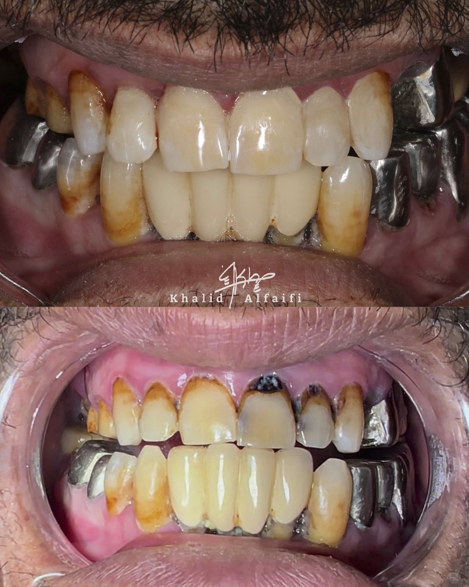 مراجع جاء إلى العياده يشتكي من تسوسات في الاسنان الاماميه 
تم إزالة التسوسات من الخمس أسنان العلويه ووضع حشوة الكمبوزت عليها في جلسة واحده✨

All soft caries has been removed-
Composite shade: b2+A3.5- 
We will continue the treatment of the remaining problems