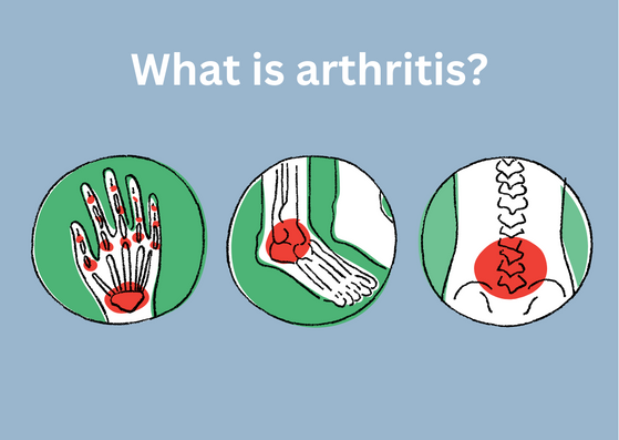 If you experience arthritis then it's important to make sure you are properly supported at work. If you need help setting up your workstation - get in touch.