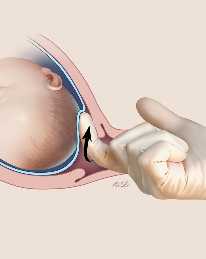 AJOG Expert Review in Labor:  Methods for the induction of labor: efficacy and safety - Membrane sweep
The act of separation of the amniotic membranes from the uterus promote the release of prostaglandins, which aid the process of cervical ripening. ow.ly/vEji50PclKq
